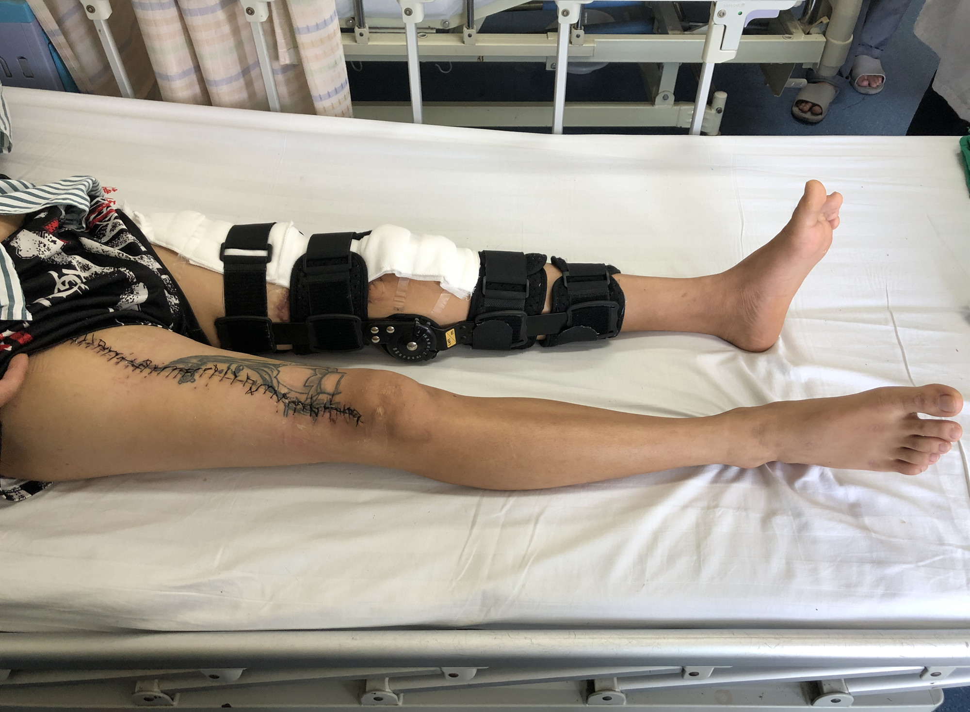 左腿掉落骨块寄养在右腿半年  海医二院回植成功