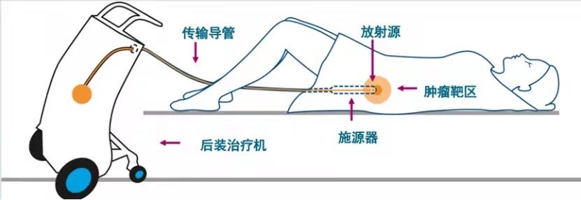 海医二院成功开展三维插植精准后装放疗技术