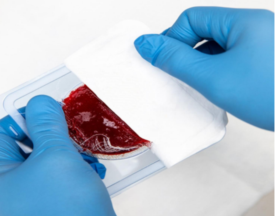 国内首次临床应用！烧伤与皮肤修复外科开展创新伤口治疗技术