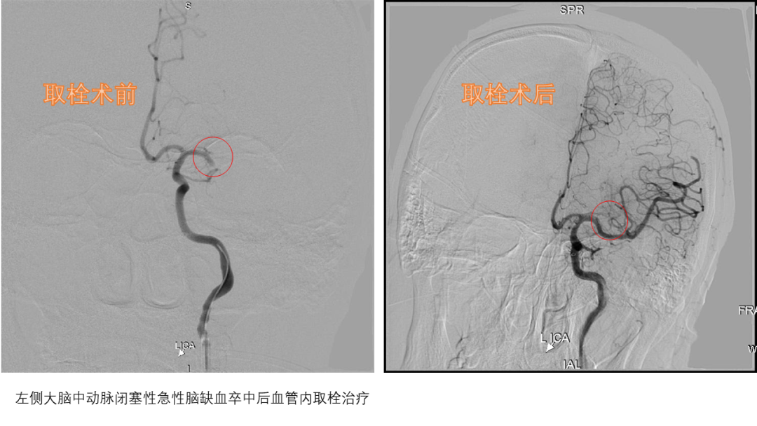 海南省第二人民医院通过神经介入手术为急性脑梗死患者成功打通“生命通道”
