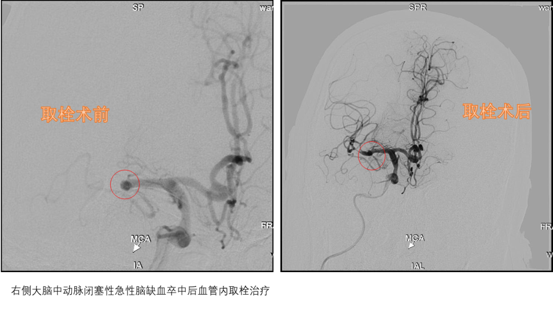 海南省第二人民医院通过神经介入手术为急性脑梗死患者成功打通“生命通道”