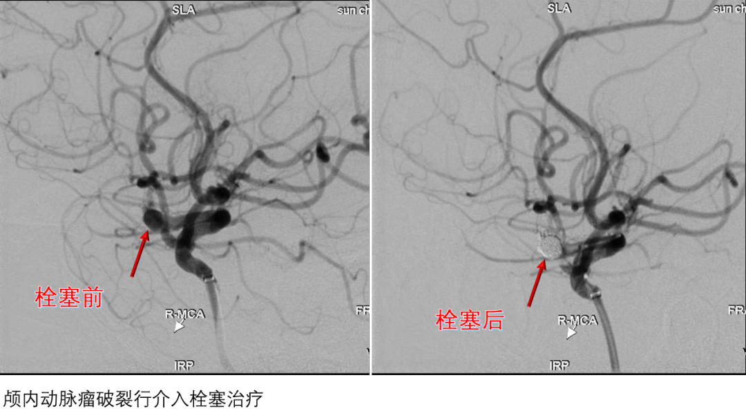 神经介入大显身手 不开颅脑巧“拆弹”