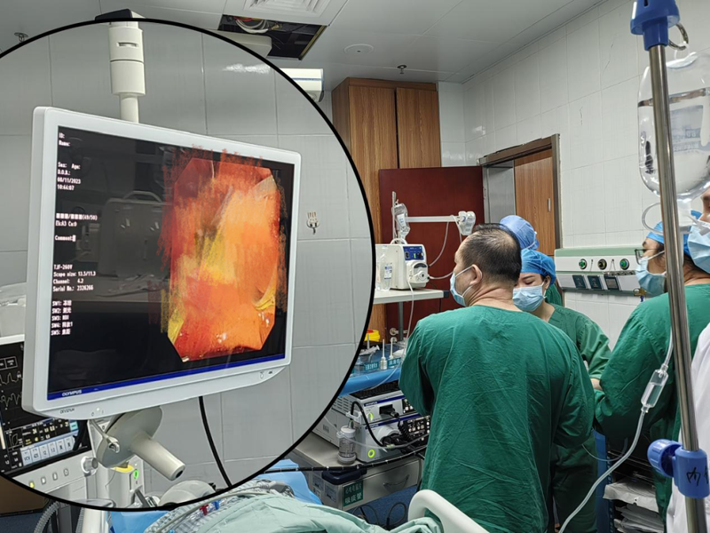 海医二院消化内镜科无射线下放支架，为孕19周孕妇解决结石问题