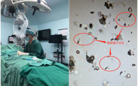 海南首例先天性无精子症患者成功生育后代