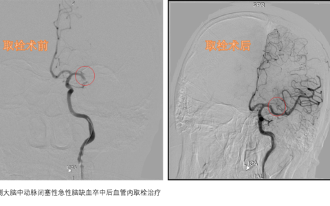海南省第二人民医院通过神经介入手术为急性脑梗死患者成功打通“生命通道”