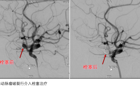 神经介入大显身手 不开颅脑巧“拆弹”