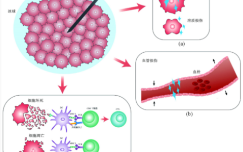 海医一附院完成肝癌冷热复合式消融治疗