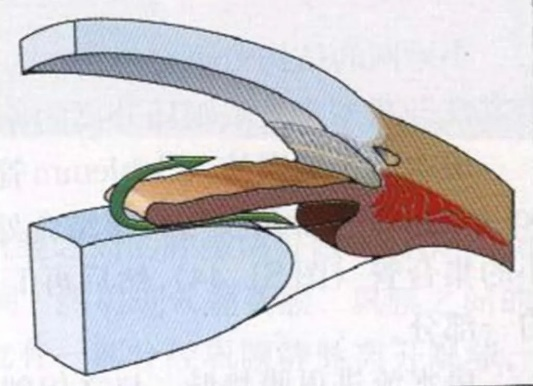 春季多发眼病,小心青光眼“找茬”