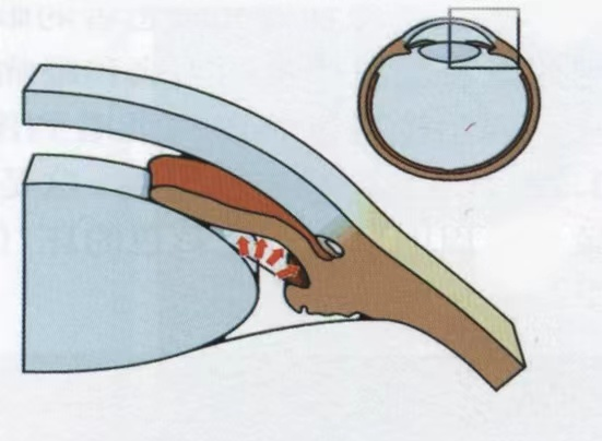 春季多发眼病,小心青光眼“找茬”