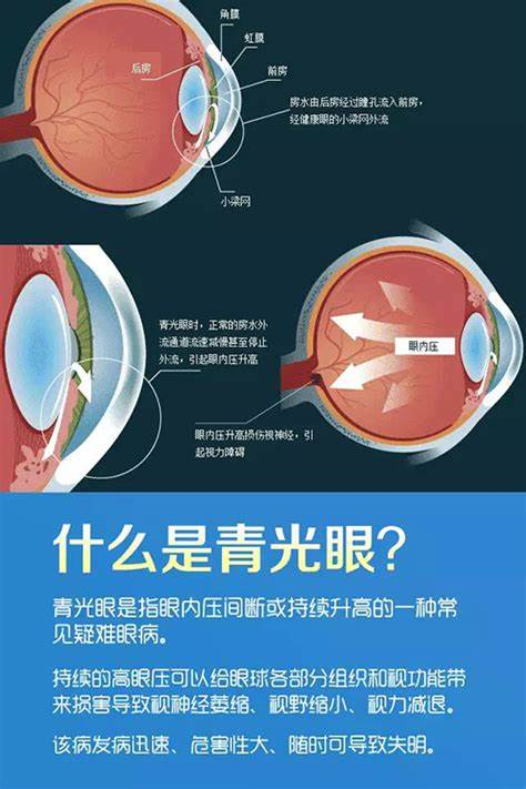 春季多发眼病，小心青光眼“找茬”