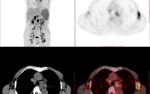 核医学检查不可怕 用好电离辐射“双刃剑”为健康护航