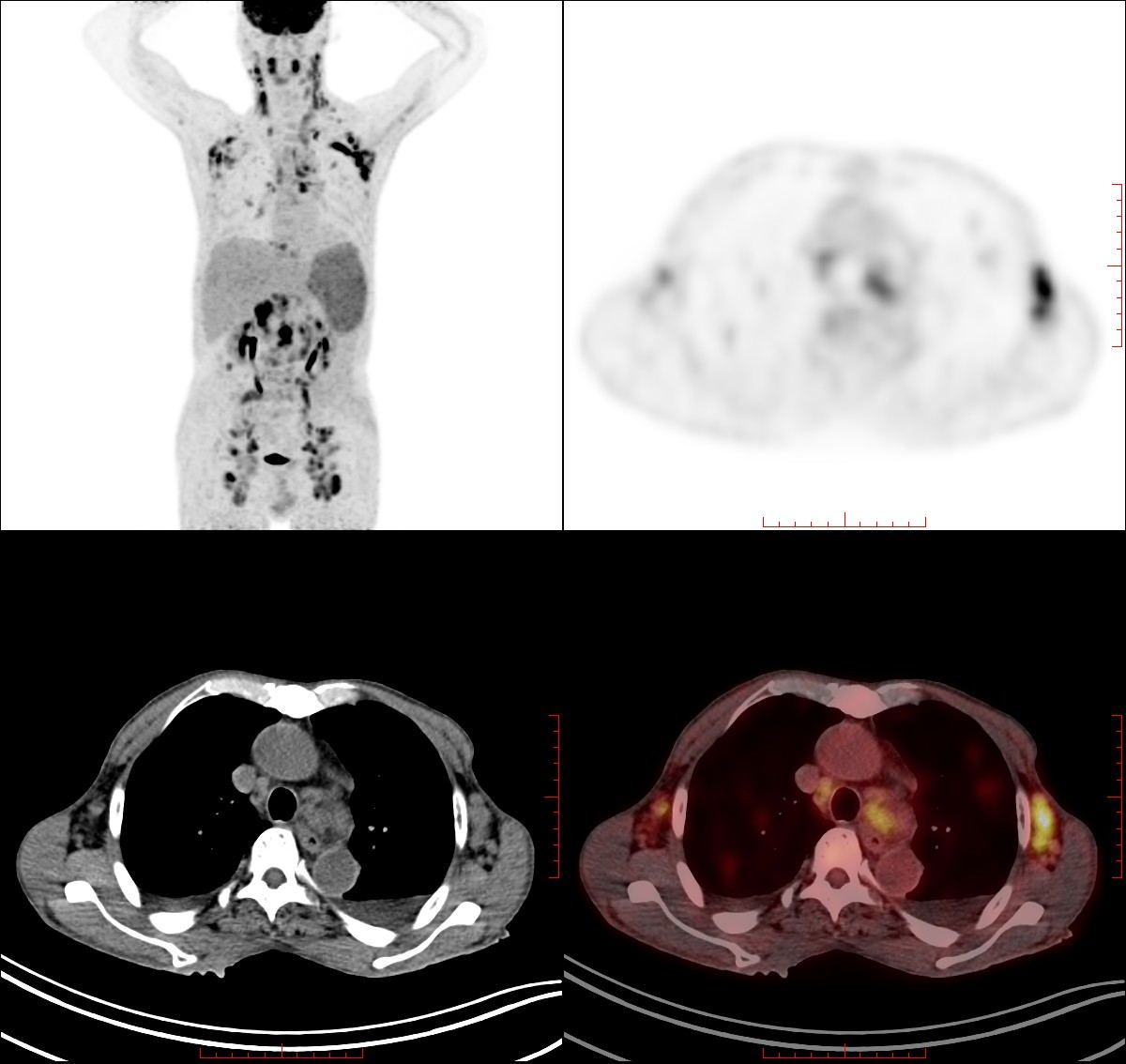 核医学检查不可怕 用好电离辐射“双刃剑”为健康护航