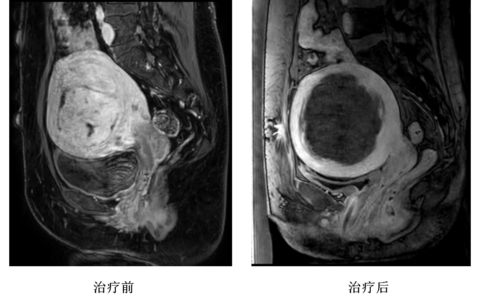 磁波刀：子宫肌瘤的“隐形杀手”