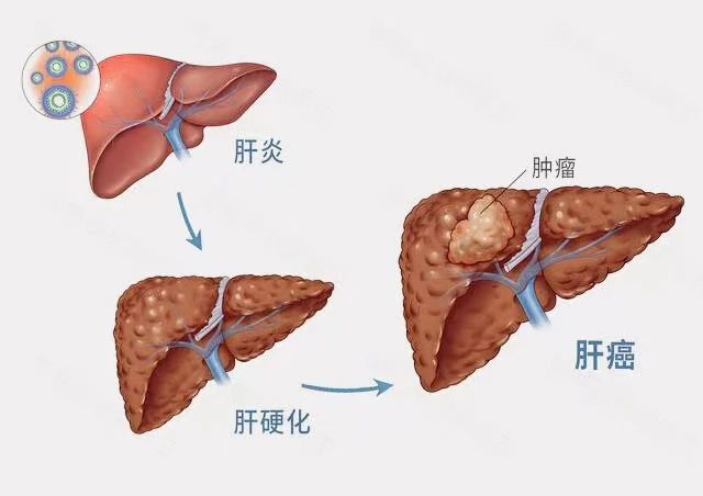 打好肝病治疗“组合拳”，海南省人民医院成功救治危重肝衰竭患者