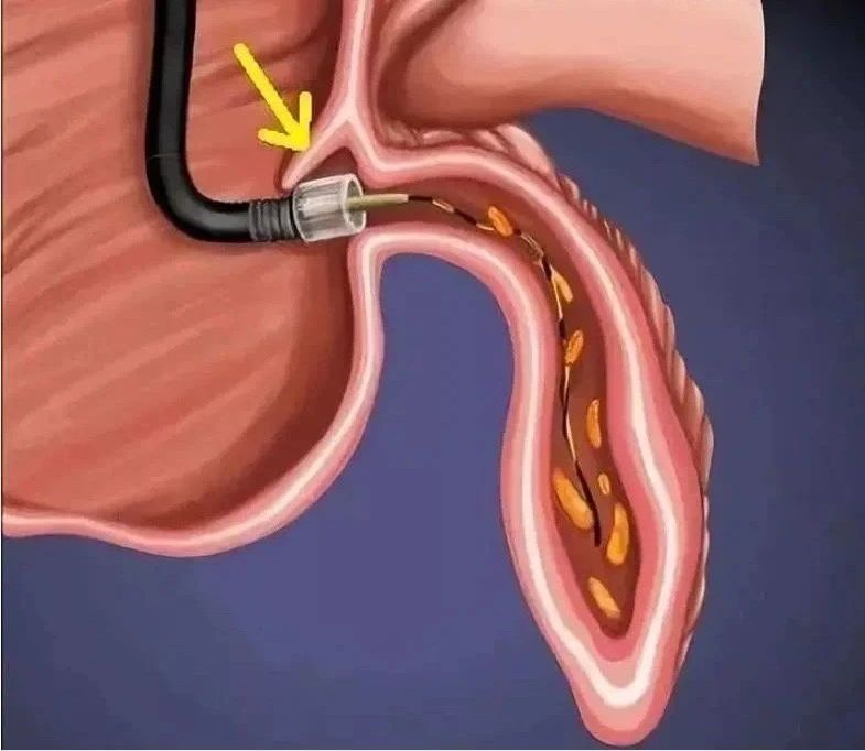 海南省人民医院消化内科成功开展首例ERAT技术