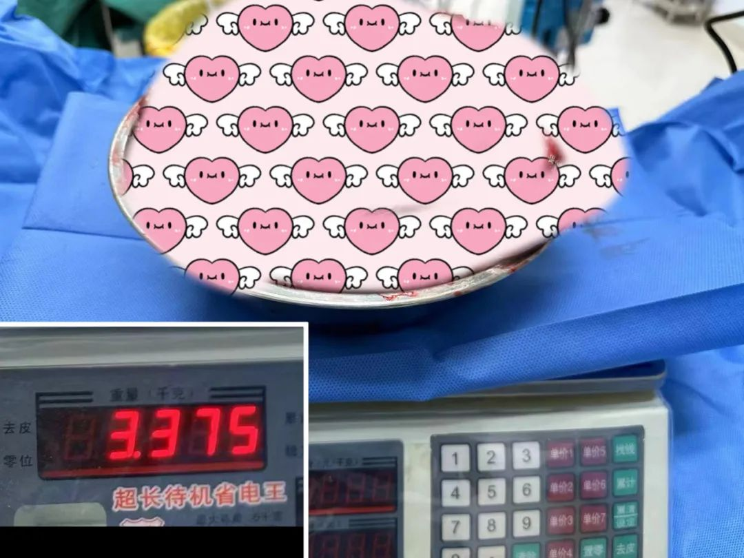 6斤肿瘤!海南省人民医院肝胆胰外科“杂交手术”为花季少女破解难题