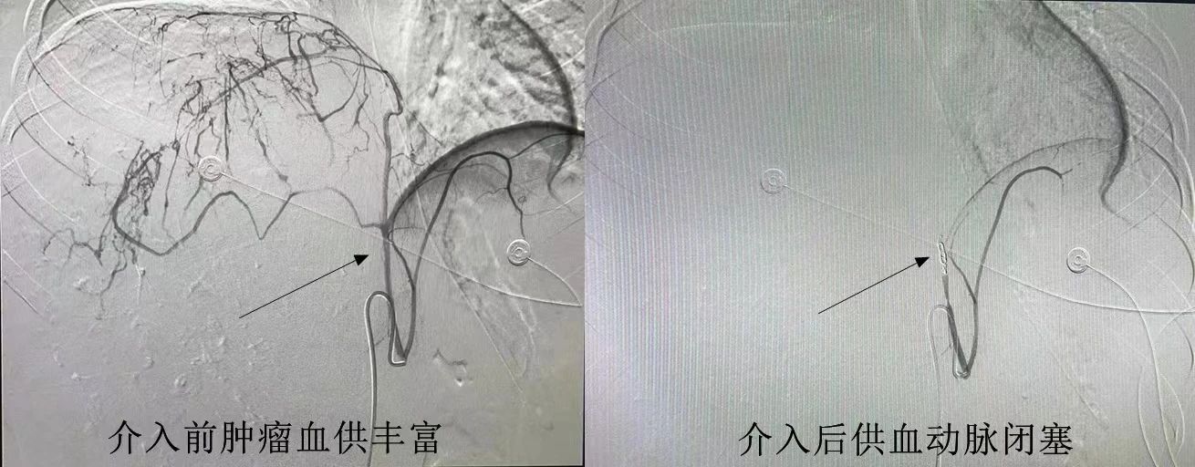 6斤肿瘤！海南省人民医院肝胆胰外科“杂交手术”为花季少女破解难题