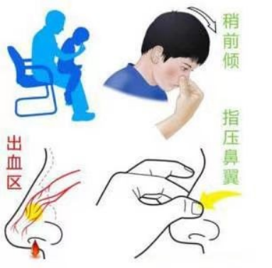 走好这六步，小儿鼻出血不用怕