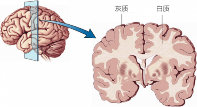 体检发现脑白质高信号怎么办？
