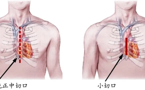 海南省人民医院开展复合微创手术，“一站式”除心病