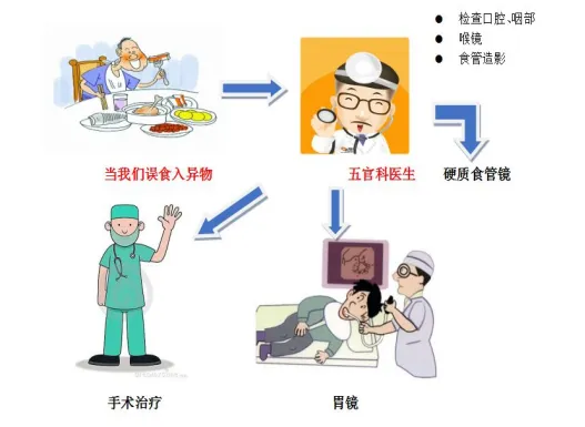 食管异物深藏不露，内镜深切取出鱼刺