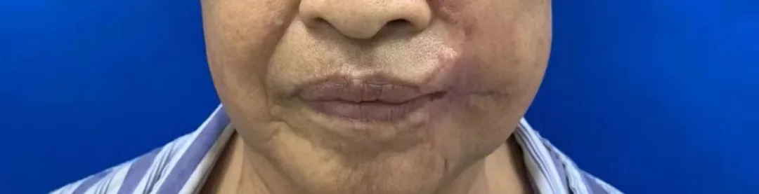 女子被狗咬破相，整形美容外科妙手回春补容颜