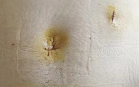 借“刀痕”巧取军嫂脾脏大肿瘤