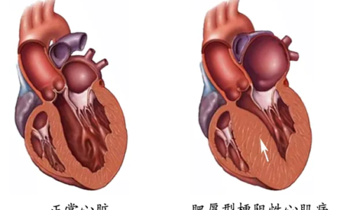 肥心病、二尖瓣和主动脉瓣关闭不全，改良“Morrow”手术一次解决