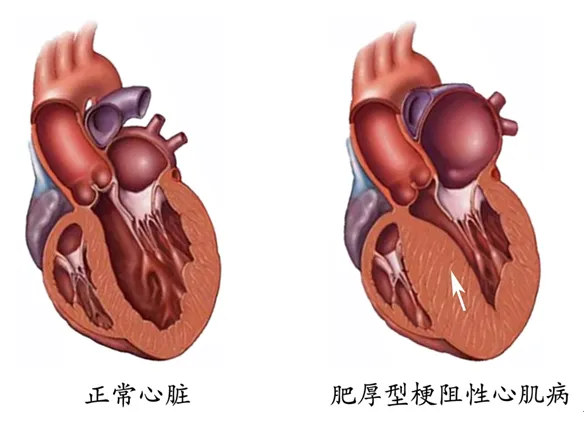 肥心病、二尖瓣和主动脉瓣关闭不全，改良“Morrow”手术一次解决