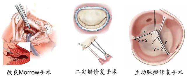 肥心病、二尖瓣和主动脉瓣关闭不全，改良“Morrow”手术一次解决