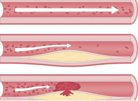 血管健康日科普：认知与应对脑动脉斑块