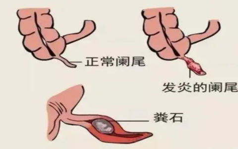 海南省人民医院椎间孔镜微创手术解决患腰椎间盘突出大问题