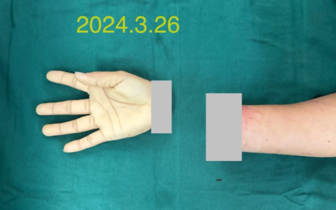 女子断腕10小时休克昏迷，海医二附院多学科联合救治保肢成功