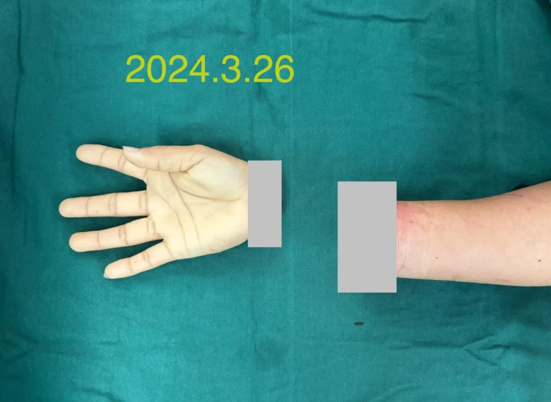 女子断腕10小时休克昏迷，海医二附院多学科联合救治保肢成功