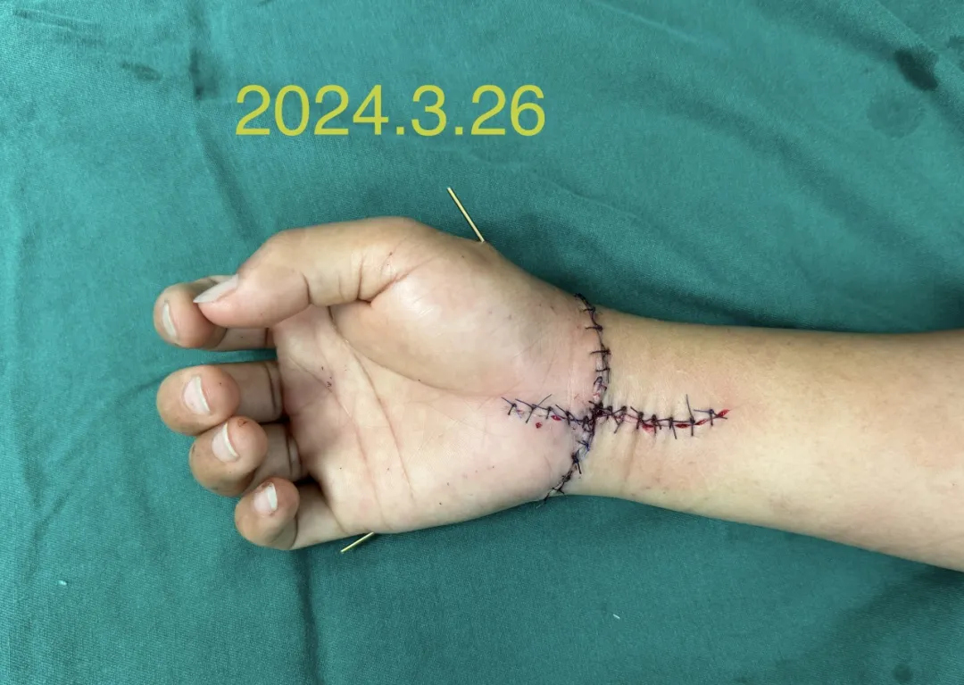 女子断腕10小时休克昏迷，海医二附院多学科联合救治保肢成功