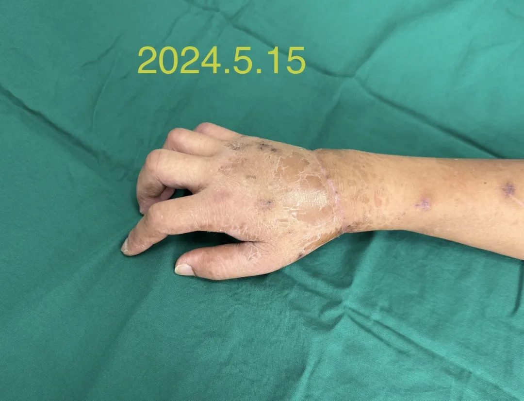 女子断腕10小时休克昏迷，海医二附院多学科联合救治保肢成功