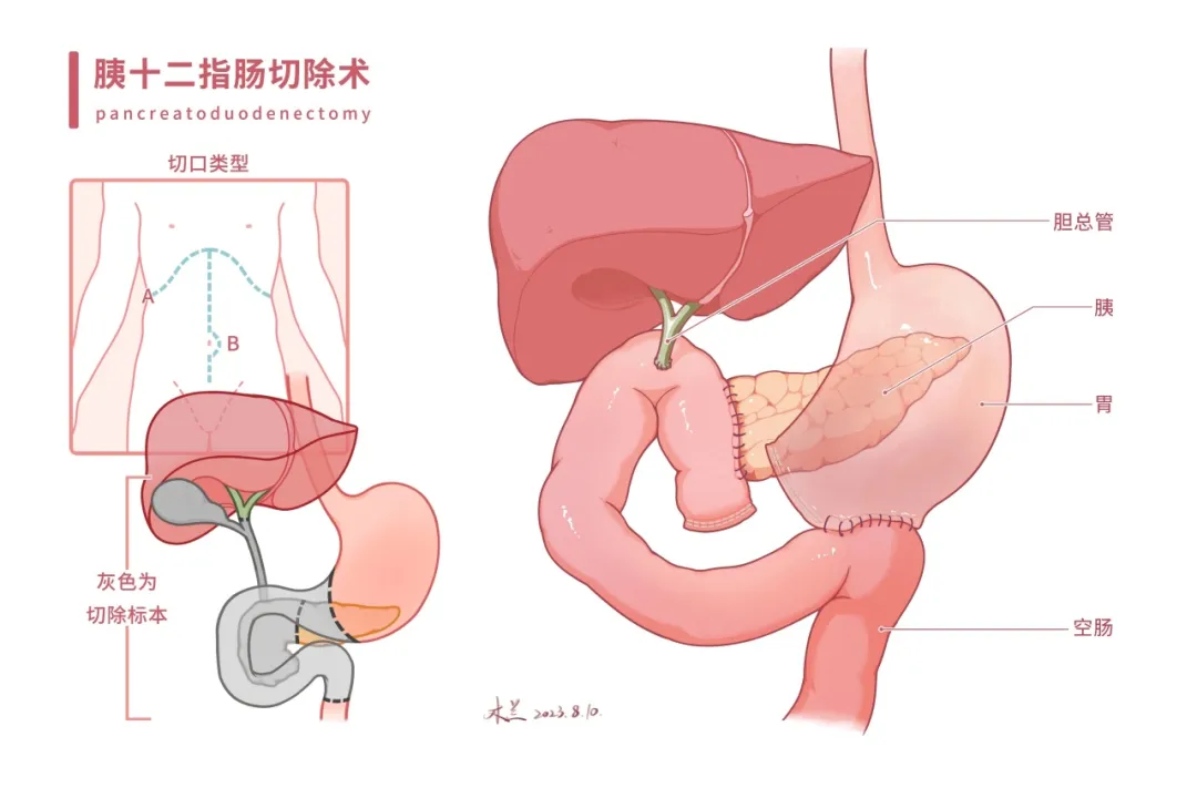 海南省人民医院肝脏外科成功为七旬阿婆实施腹腔镜下胰十二指肠切除术