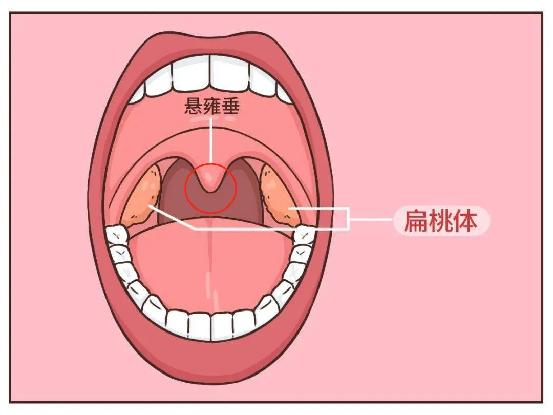 一根头发丝竟然在7月龄宝宝的喉咙打了个结...