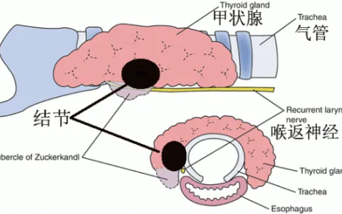 甲状腺癌拖延治疗致局部晚期侵犯气管 海医一附院多学科专家巧手拆“雷”