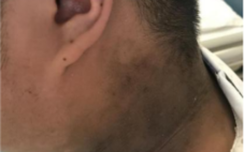 请注意孩子的“黑脖子”，小心黑棘皮病