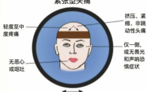 你了解紧张型头痛吗？