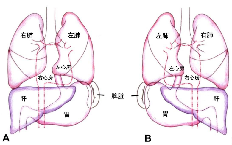发生率百万分之一!海南省老年病医院成功完成一例“镜面人”微创胆囊切除手术