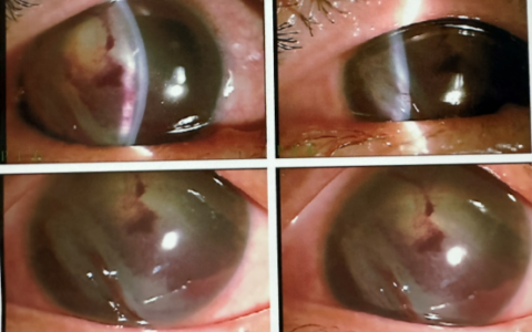 万宁一男子抗风中眼睛受伤 海医一附院眼科紧急救治