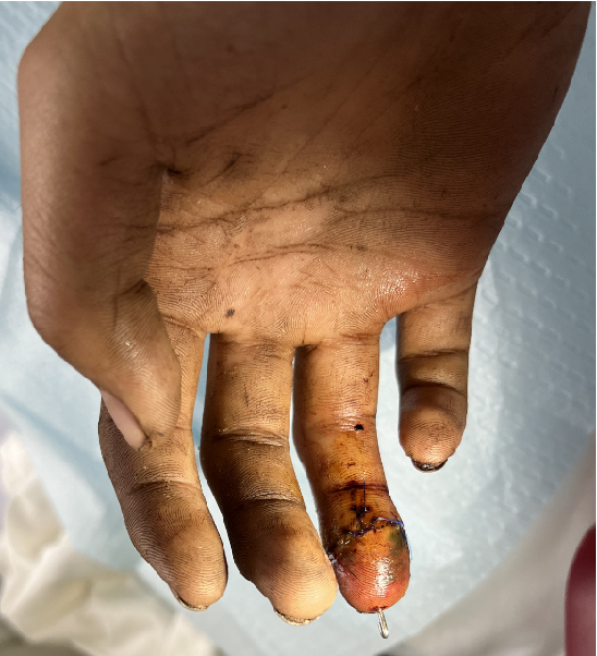 1小时加速度！ 海南省人民医院显微手外科断指再植再次刷新记录