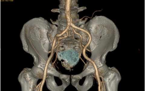 多学科团队联手，海医一附院成功挑战高龄高难度骶骨肿瘤手术