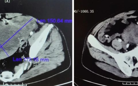 7旬老翁肚大如孕妇，原来是3公斤肿瘤“作祟”