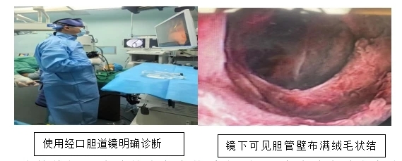 海医二附院首例!肝胆胰外科成功完成左半肝联合胰十二指肠切除术