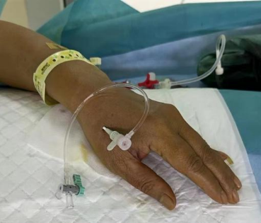 神经介入新技术：解放军总医院海南医院使用经桡动脉脑血管造影术让患者受益