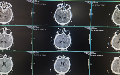 “不定时炸弹”颅内动脉瘤破裂，三亚哈医大鸿森医院神经外科微创介入手术成功“拆除”