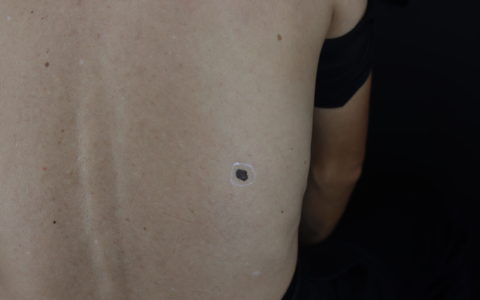 警惕“黑痣”癌变风险